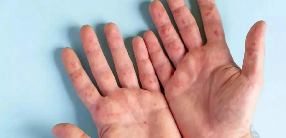 Önce corona ve maymun çiçeği, şimdi de domates gribi çıktı