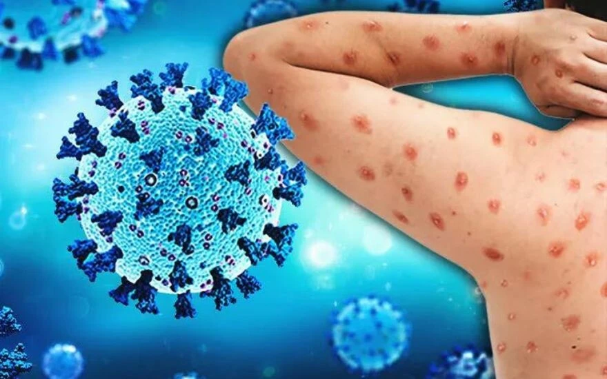 Çocukları hedef alan yeni salgın: Domates gribi alarmı (Domates gribi nedir? Domates gribinin belirtileri nelerdir? Domates gribi tedavi edilir mi?)