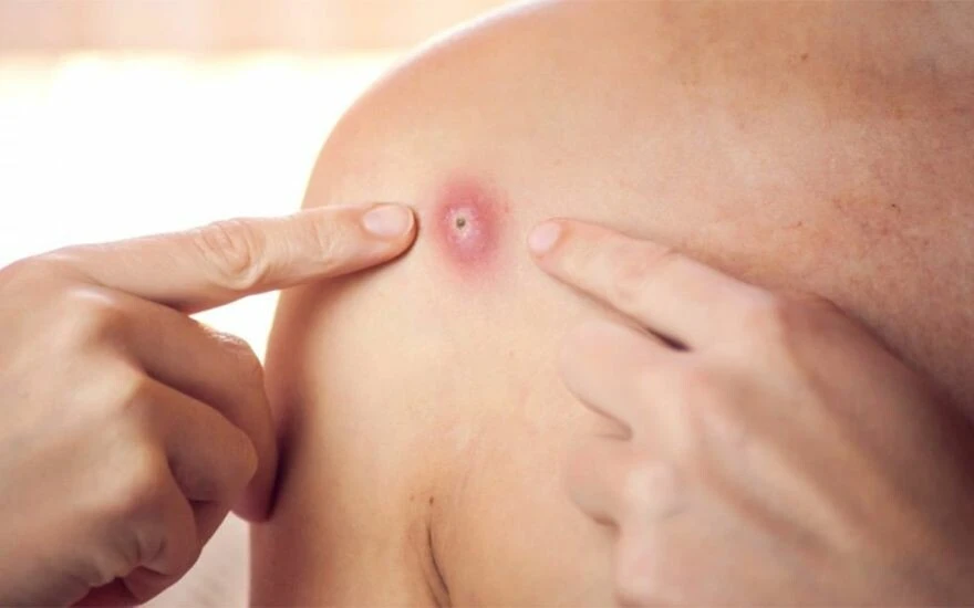 3 virüsü birden taşıyan tek hasta: Yaptırdığı maymun çiçeği, Covid ve HIV testleri pozitif çıktı