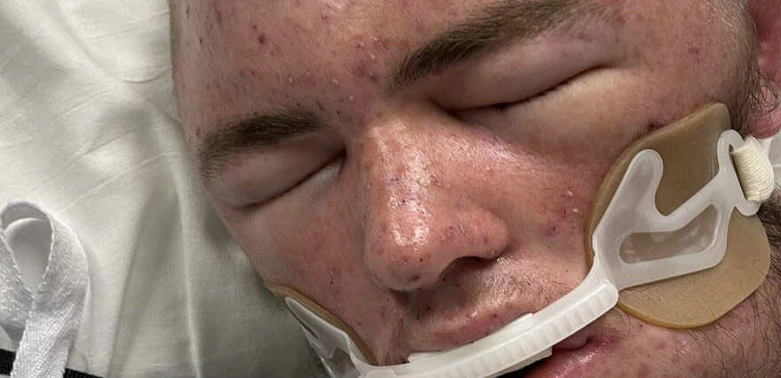 20 bin arının soktuğu gençten iyi haber geldi: Yaşam mücadelesini kazandı