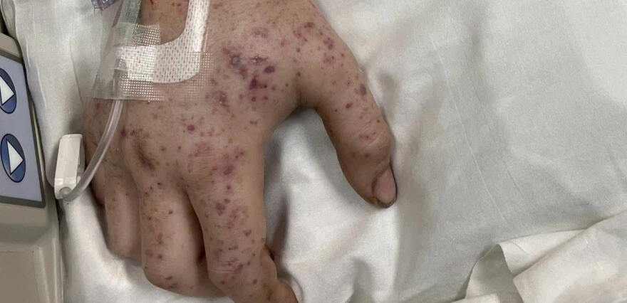 20 bin arının soktuğu gençten iyi haber geldi: Yaşam mücadelesini kazandı