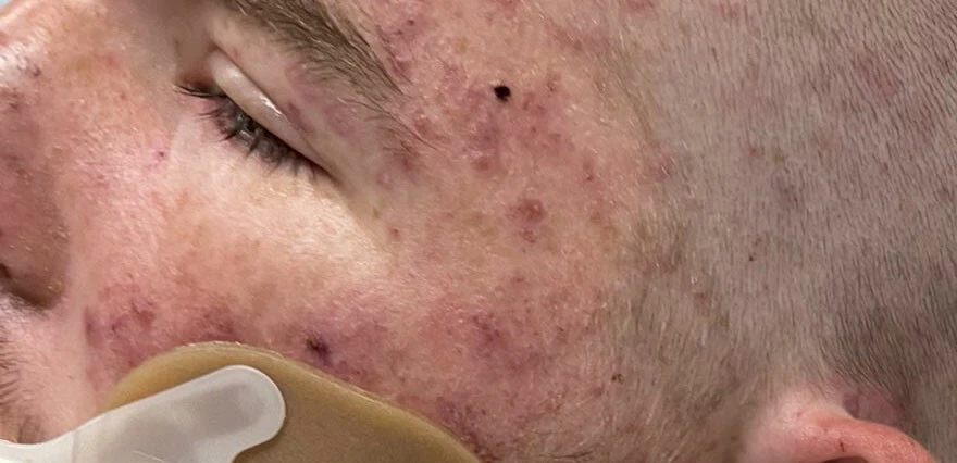 20 bin arının soktuğu gençten iyi haber geldi: Yaşam mücadelesini kazandı