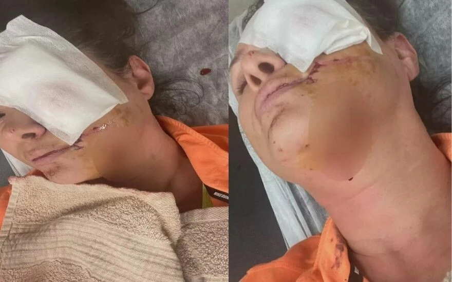 Rafet El Roman’ın eski eşi Tuğba Altıntop’a köpek saldırdı: Yüzü tanınmayacak hale geldi!