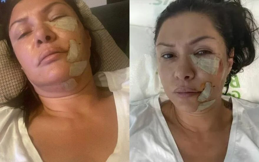 Rafet El Roman’ın eski eşi Tuğba Altıntop’a köpek saldırdı: Yüzü tanınmayacak hale geldi!