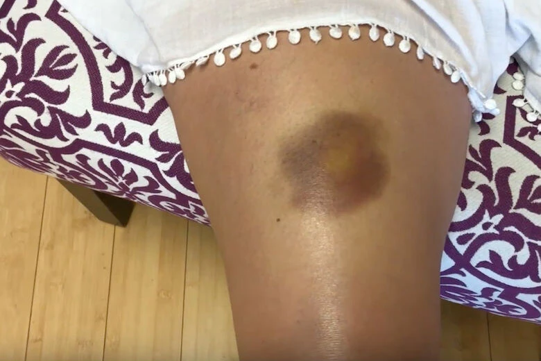 Cildiniz çok mu hızlı morarıyor? Nedeni bazı vitaminlerin eksikliği olabilir