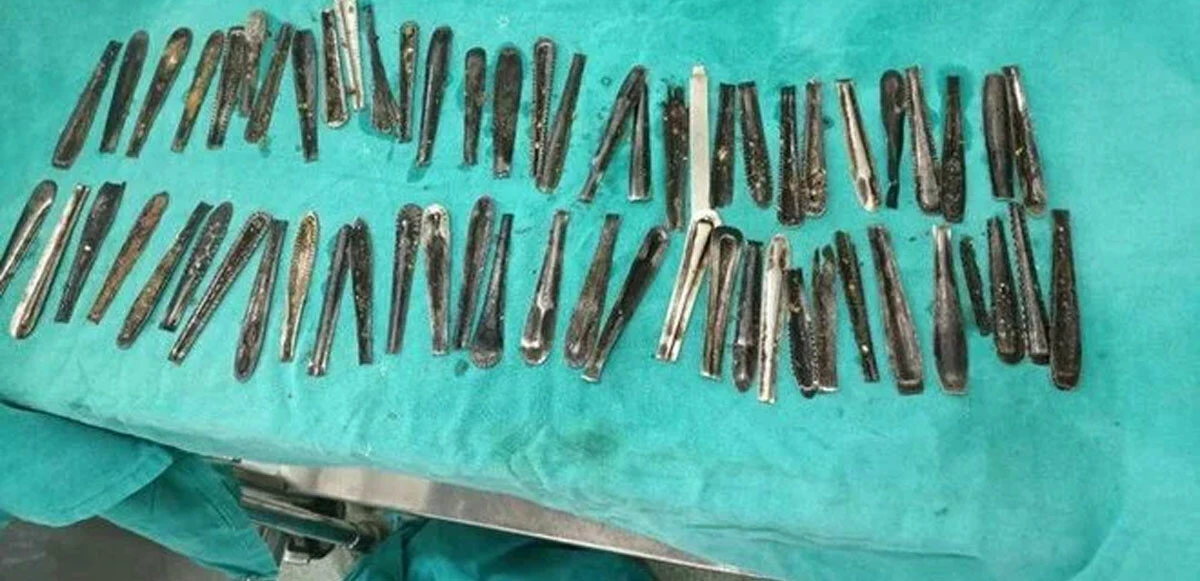 Pika Sendromu nedir? Karın ağrısıyla gitti doktorlar midesinden çıkanlara şoke oldu