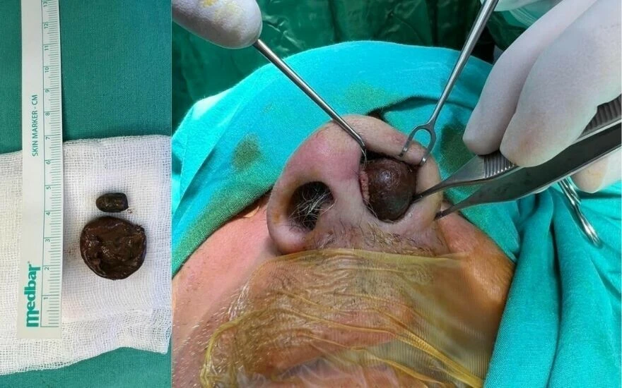 13 yaşındayken burnuna giren mermi 50 yıl sonra çıkartıldı!