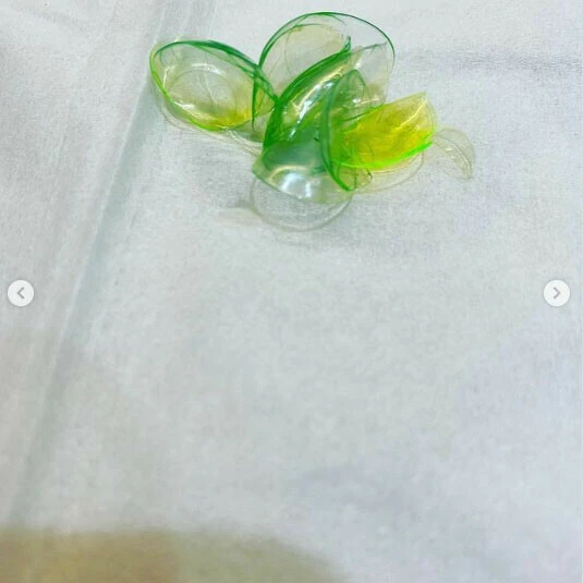 Gözünde unuttuğu kontakt lensler hayrete düşürdü! Doktor 23 tane çıkardı