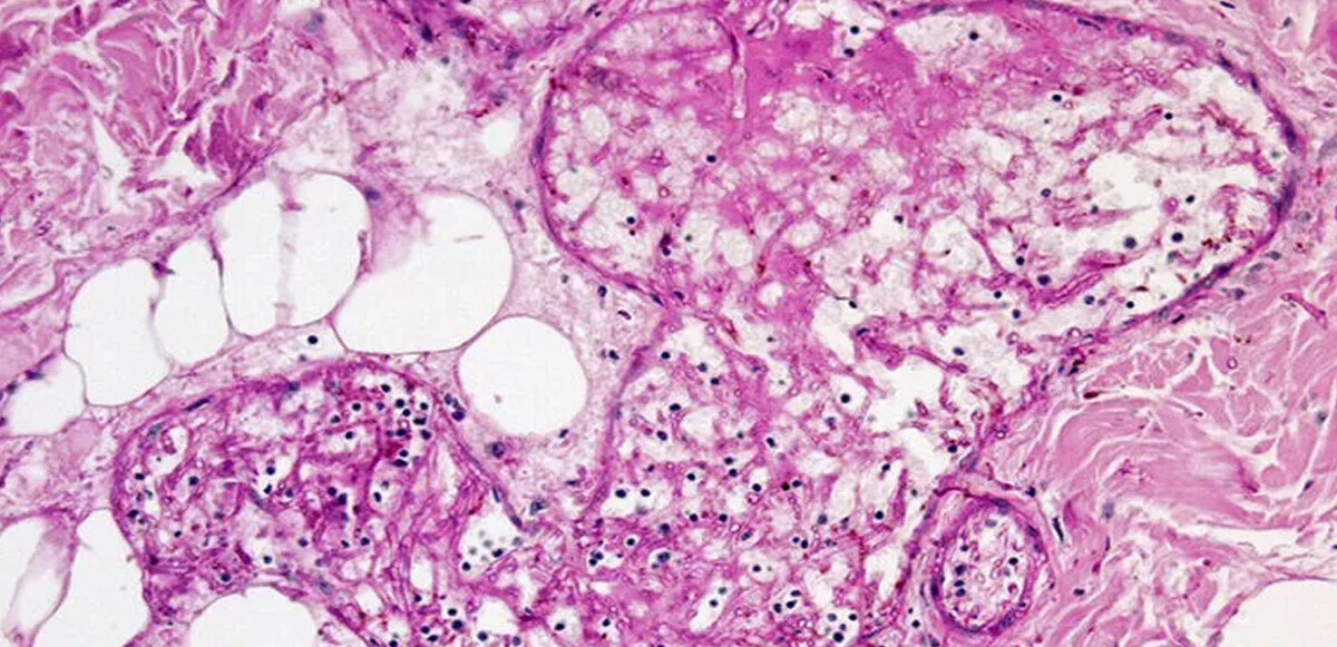 DSÖ bu kez adını koydu! İşte yeni öldürücü tehdit: Mantarlar!