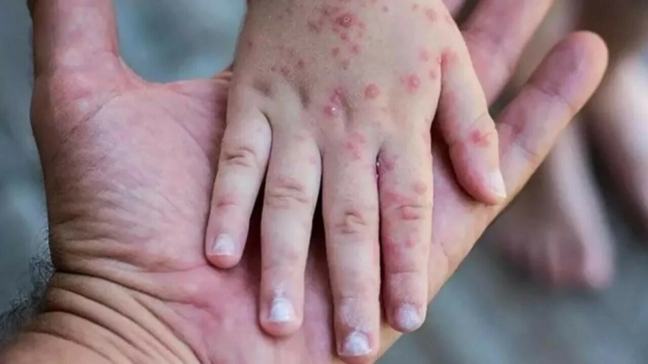 Maymun çiçeği ve AIDS birleşimi öldürebiliyor! CDC'den erken tanı uyarısı