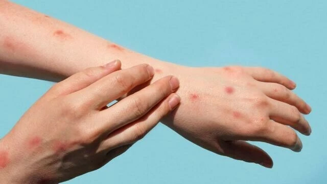 Maymun çiçeği ve AIDS birleşimi öldürebiliyor! CDC'den erken tanı uyarısı