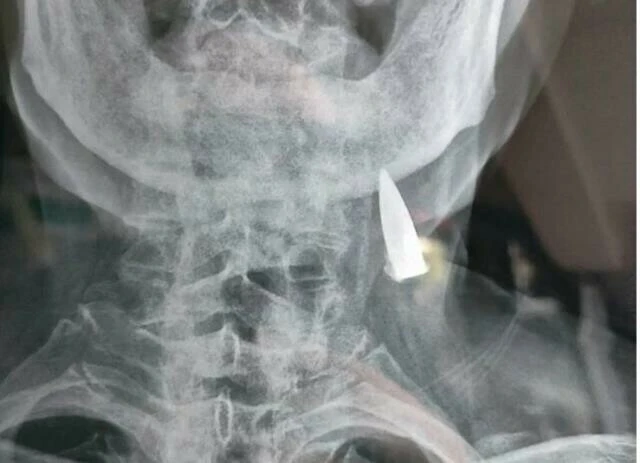 Boyun ve baş ağrısıyla gitti doktorları hayrete düşürdü! 95 yaşındaki adam tedaviyi de reddetti