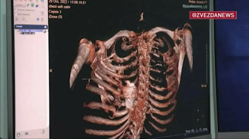 Rus askerin göğsünden patlamamış el bombası çıktı: Doktorlar kendi canlarını hiçe sayarak ameliyat etti