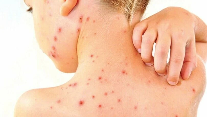 Milyonlarca çocuk aşılanmadı! DSÖ uyardı: Kızamık büyük bir salgına neden olabilir