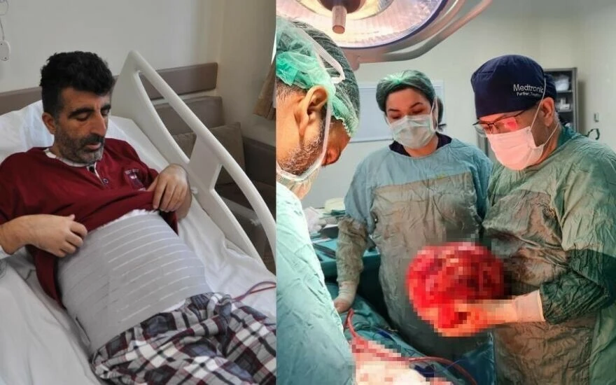 Kilo aldığını sanarak doktora giden adamın karnından çıkanlar şoke etti!