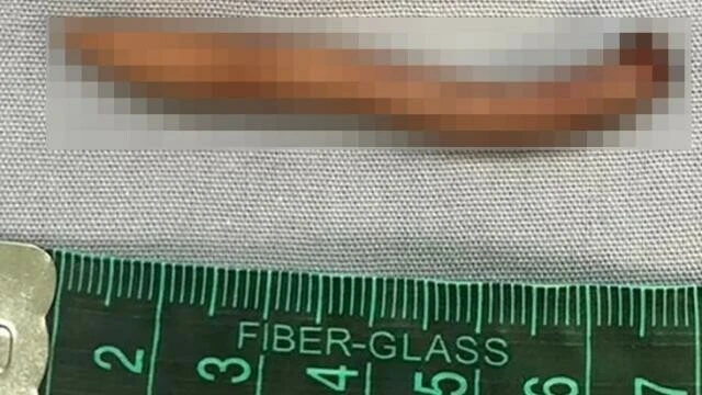 Gerçek kuyrukla dünyaya gelen bebek tıp camiasını şaşırttı! 5.7 cm uzunluğunda kuyruğu gören şaştı