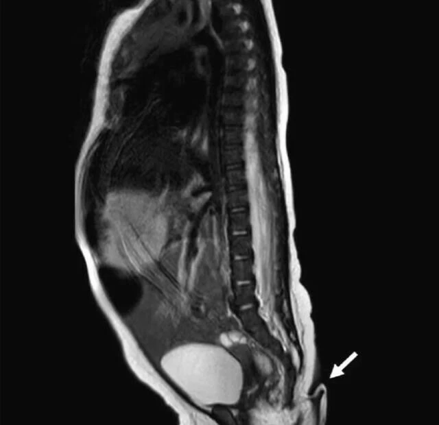 Gerçek kuyrukla dünyaya gelen bebek tıp camiasını şaşırttı! 5.7 cm uzunluğunda kuyruğu gören şaştı