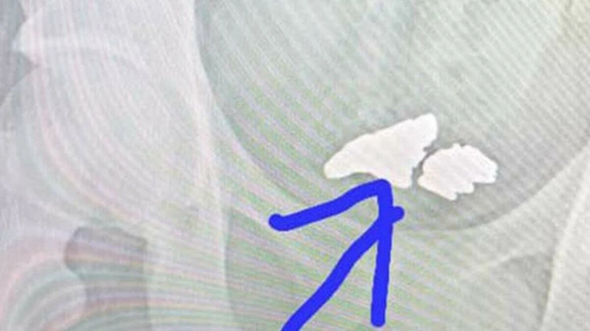 Madenden altın çalmak için akıl almaz yöntem! Her şey hastanede gün yüzüne çıktı