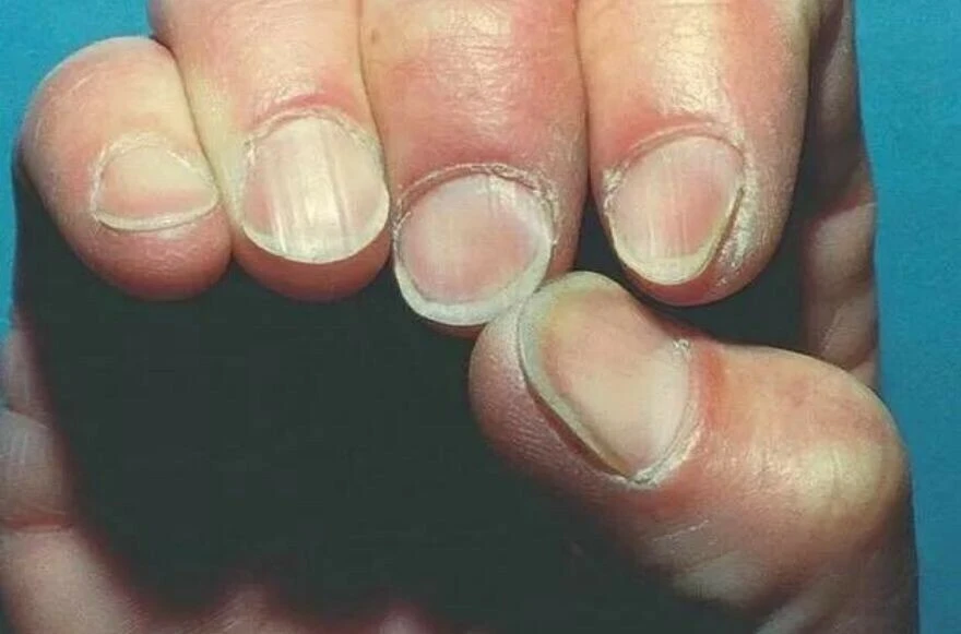 Tırnaktaki şekil ve renk bozuklukları ne anlatır? Sağlıklı tırnak nasıl olmalı?