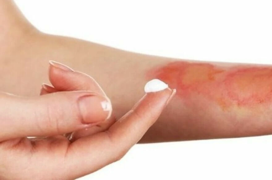 Sakinlik ve soğukkanlılık en önemli ipucu! İşte cilt yanıklarında ilk müdahalede yapılması gerekenler!