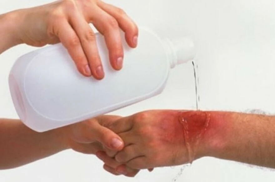 Sakinlik ve soğukkanlılık en önemli ipucu! İşte cilt yanıklarında ilk müdahalede yapılması gerekenler!