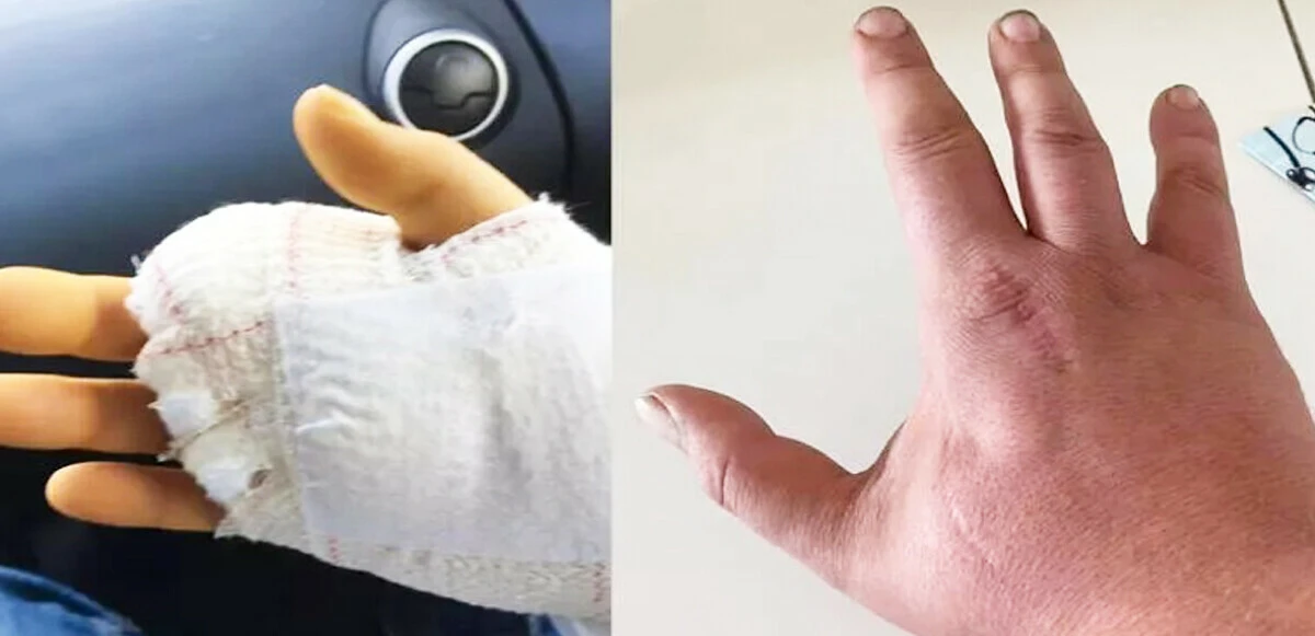 Yavru kedi ısırığı sonrası hayatını kaybetti! Sebebi et yiyen bakteri