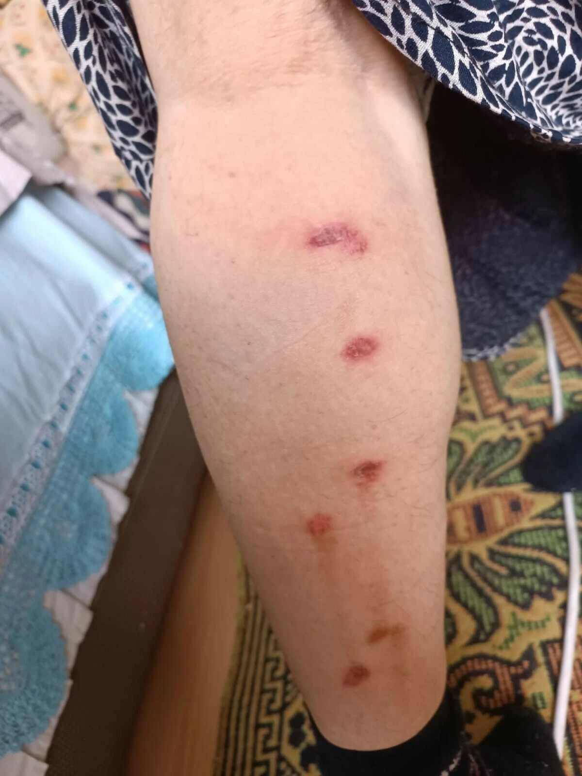 Bir güzellik merkezi skandalı daha: Lazer işleminde kadının vücudunu yaktılar