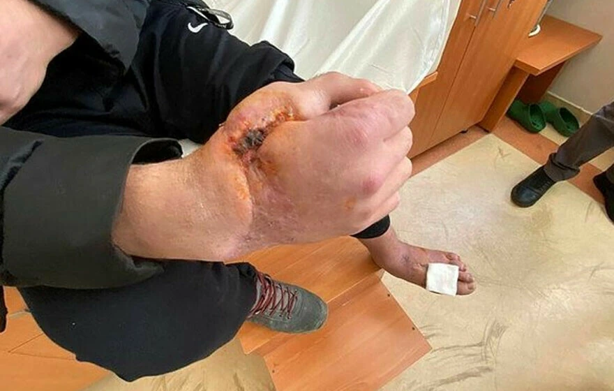 Kopan el parmağına ayak parmağı nakledildi