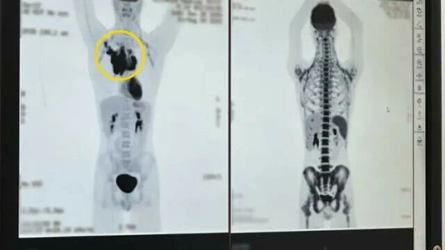 Sporda yaşadığını kas çekilmesi sandı doktorun açıklamasıyla sarsıldı!